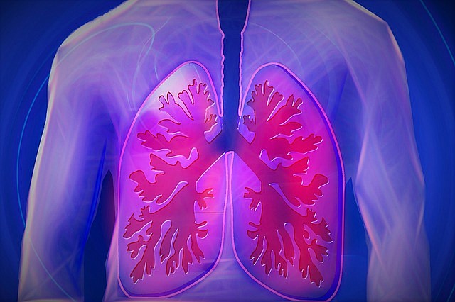 Pixabay/Free lung cancer screeings will be available at Shore Medical Center.