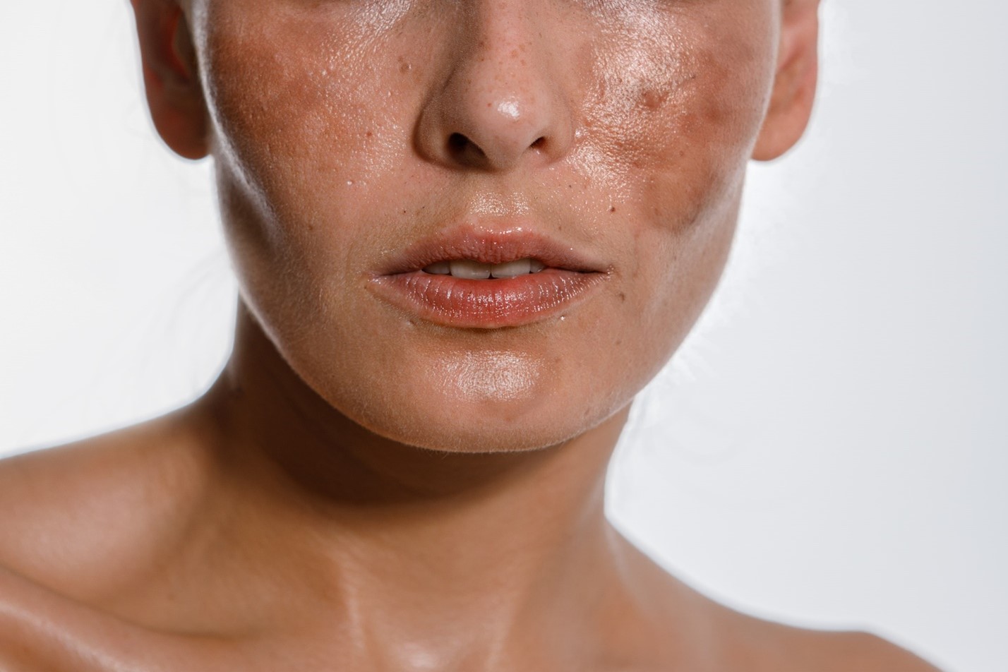 Dr Jason Emer Reviews Advanced Treatments for Hyperpigmentation, Discoloration, and Melasma