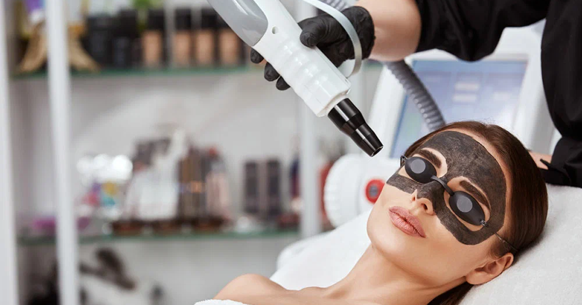 Carbon Laser Facial